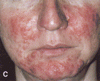 Papulopustular rosacea