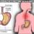 What is Acid Reflux and What are Its Symptoms