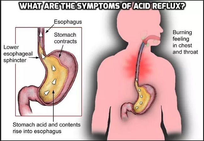 What is Acid Reflux and What are Its Symptoms
