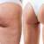 Treat Cellulite and Get Rid of Lumpy Skin without Any Pain