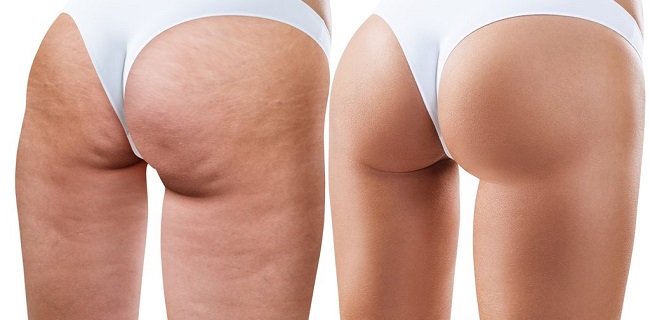 Treat Cellulite and Get Rid of Lumpy Skin without Any Pain