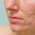 Best Products for Acne Scars