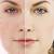 5 Tips on How to Get Rid of Acne