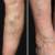 Varicose Veins: Things You Should Know