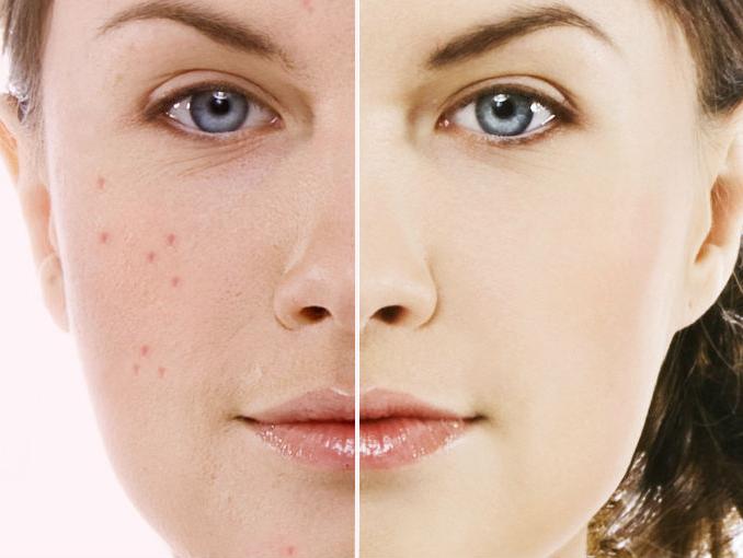 5 Tips on How to Get Rid of Acne