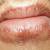 How To Get Rid Of Chapped Lips
