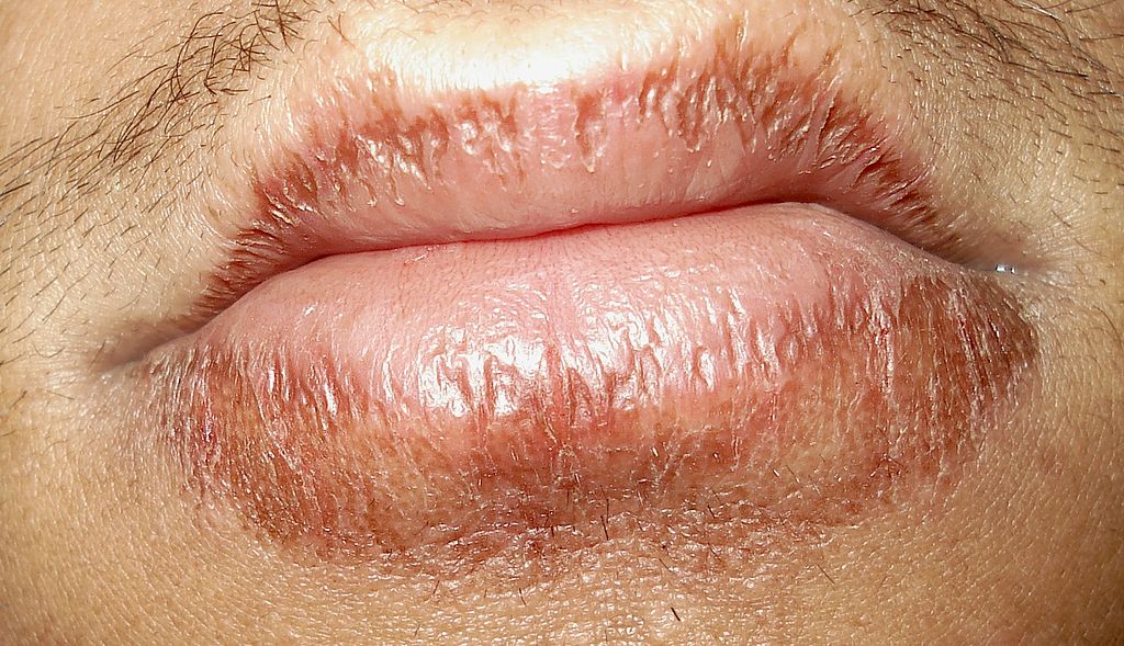 How To Get Rid Of Chapped Lips