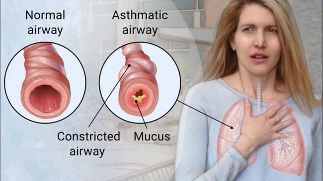 5 Natural Therapies Useful in Treatment of Asthma