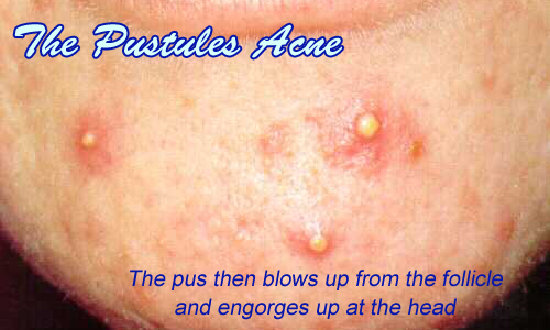 types of acne pictures