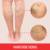 The Science Behind Spider Veins