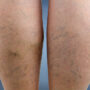 Varicose Veins Causes Symptoms Treatment and Prevention