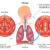 Chronic Hiccups