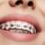First Weeks In Braces: Do’s And Don’ts of Braces