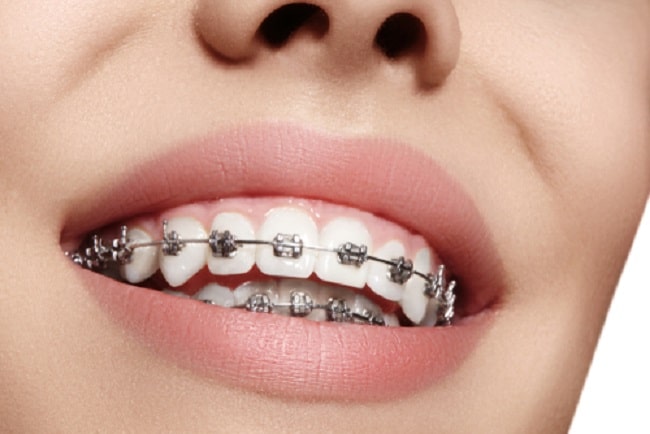 First Weeks In Braces Do’s And Don’ts