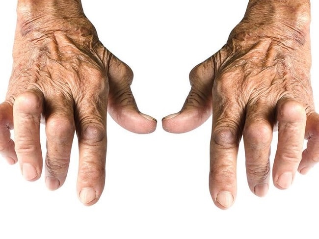 Steroids for Rheumatoid Arthritis