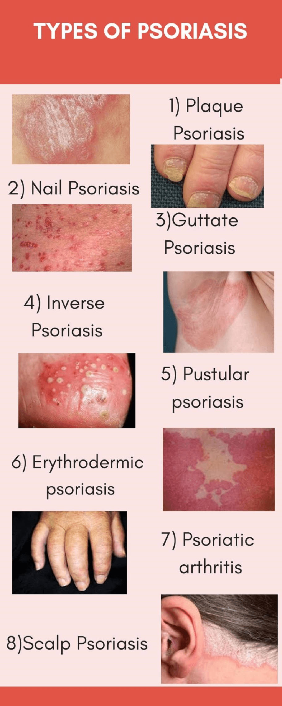 types of psoriasis