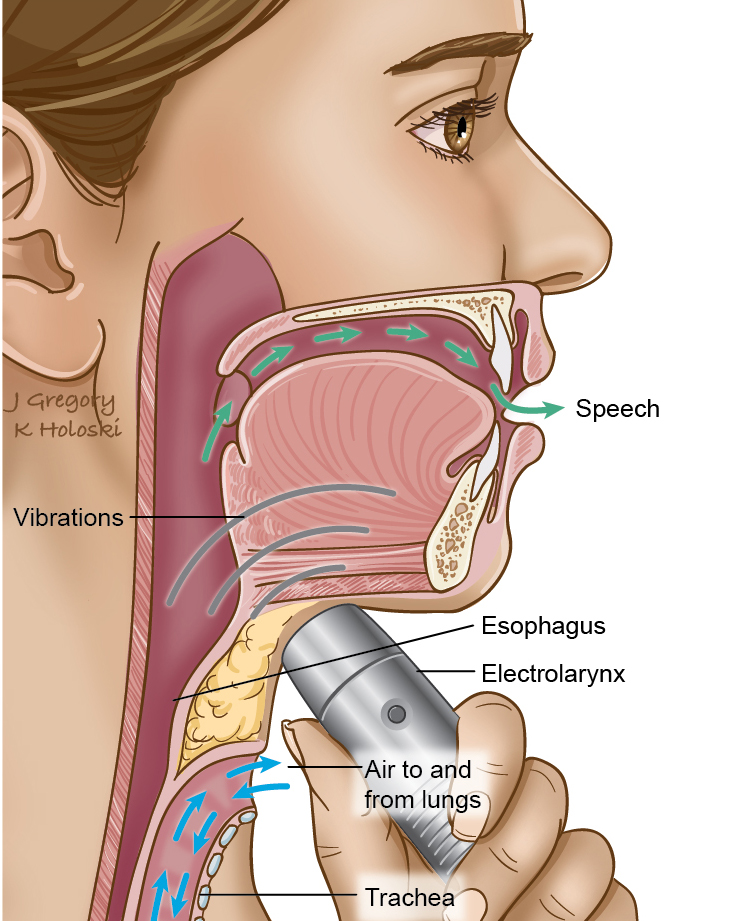 electrolarynx