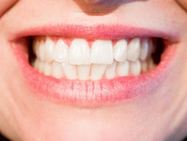 Benefits of Professional Teeth Whitening