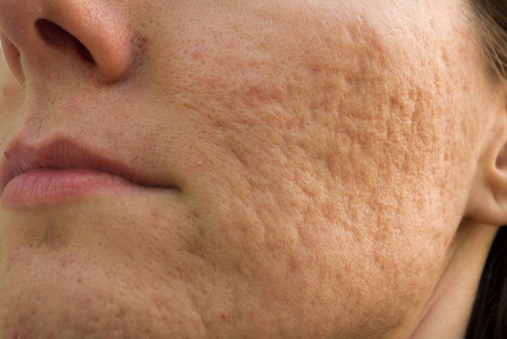 How to Get Rid of Acne Scars