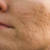 How to Get Rid of Acne Scars