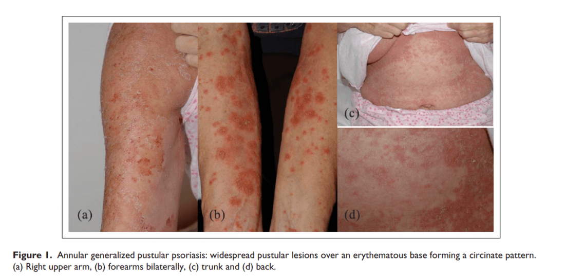 Annular Pustular Psoriasis