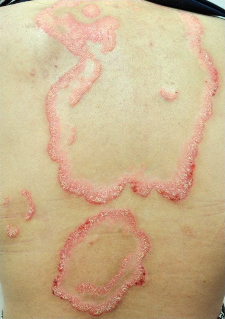 Annular Pustular Psoriasis