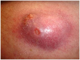 nodular acne