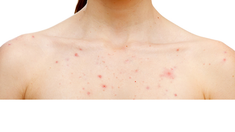 How To Get Rid Of Chest Acne