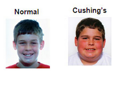 Cushing’s Disease