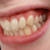 How To Get Rid of White Spots on Teeth