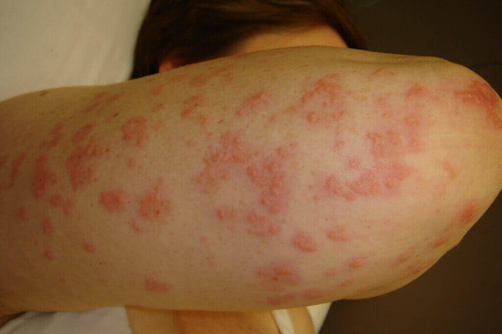 Dermatitis Herpetiformis symptoms