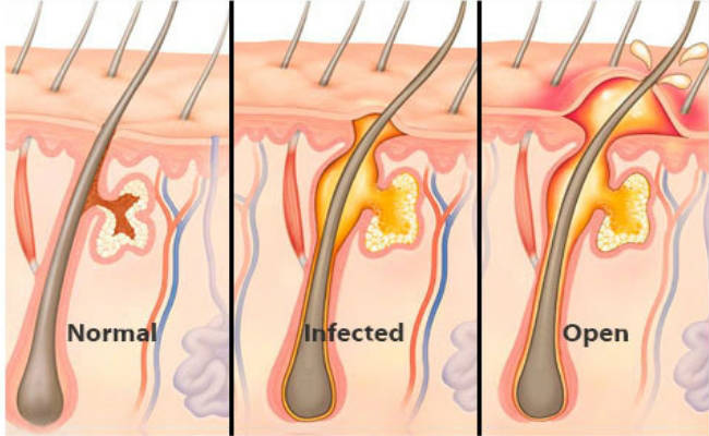 How To Get Rid Of Boils