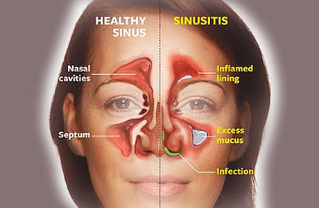 What is sinus congestion?