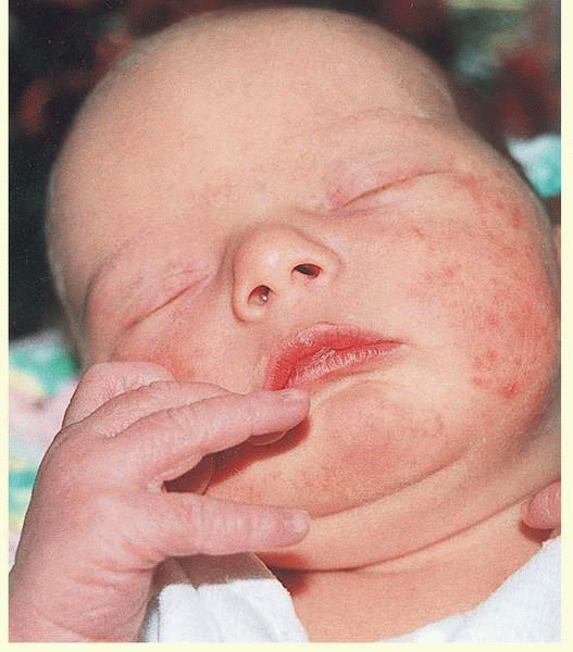 Erythema toxicum