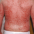 Erythrodermic Psoriasis