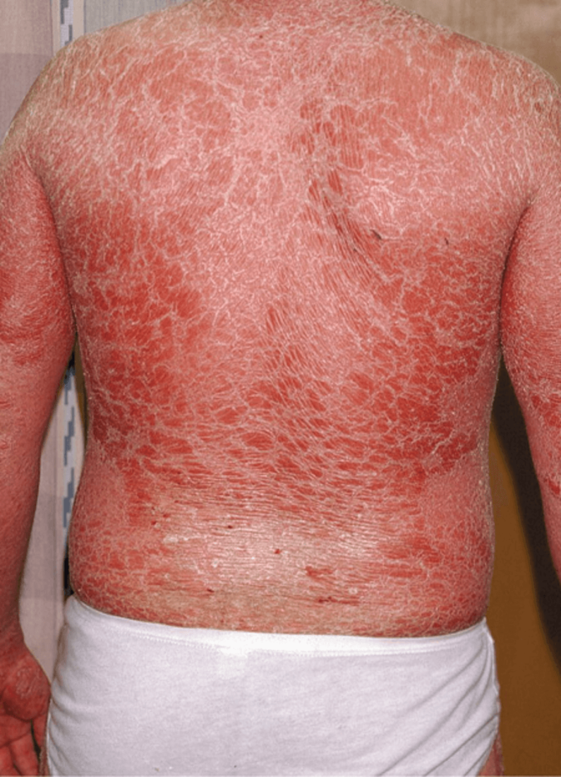 Erythrodermic Psoriasis