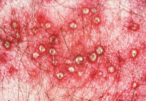 gram Folliculitis