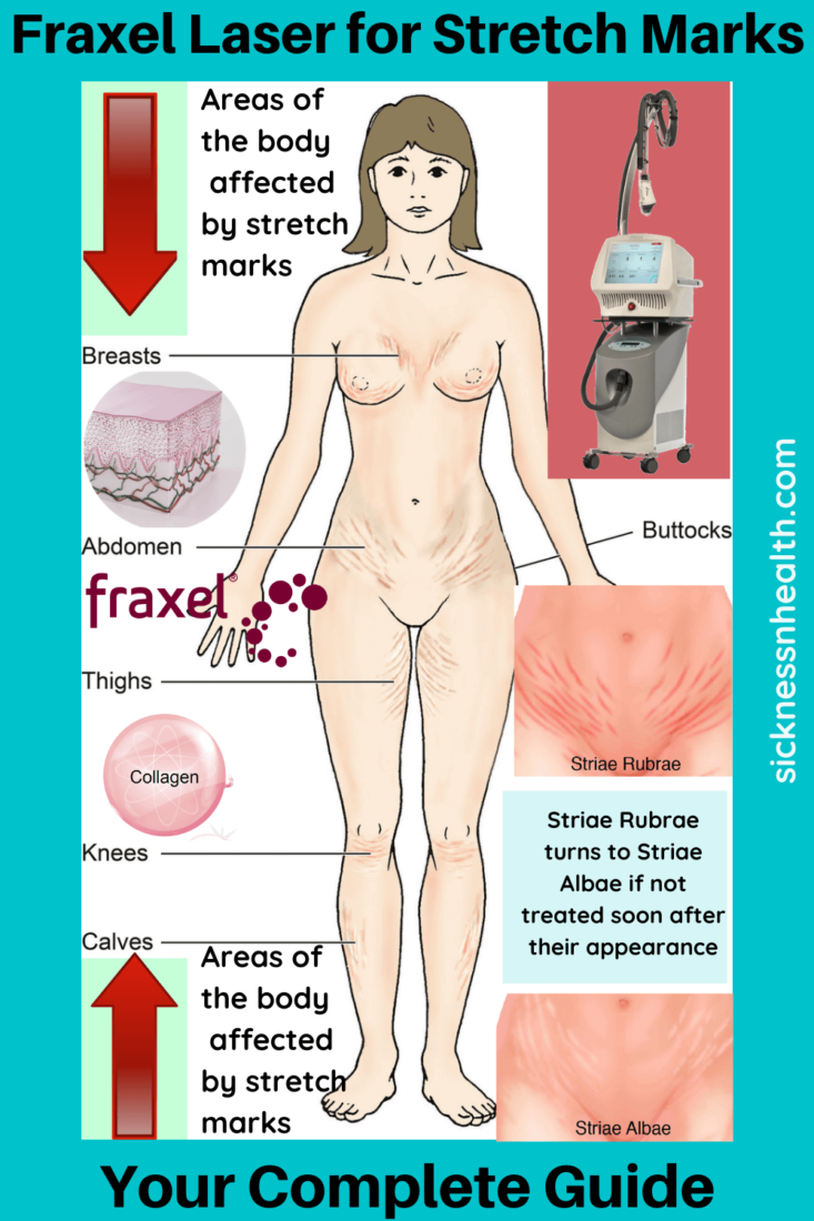 Fraxel Laser for Stretch Marks - Laser Therapy for Stretch Marks - Stretch Marks Removal - How to Get Rid of Stretch Marks Fast