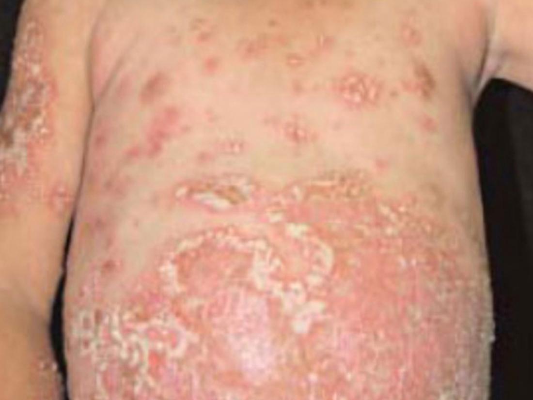 Generalized Pustular Psoriasis