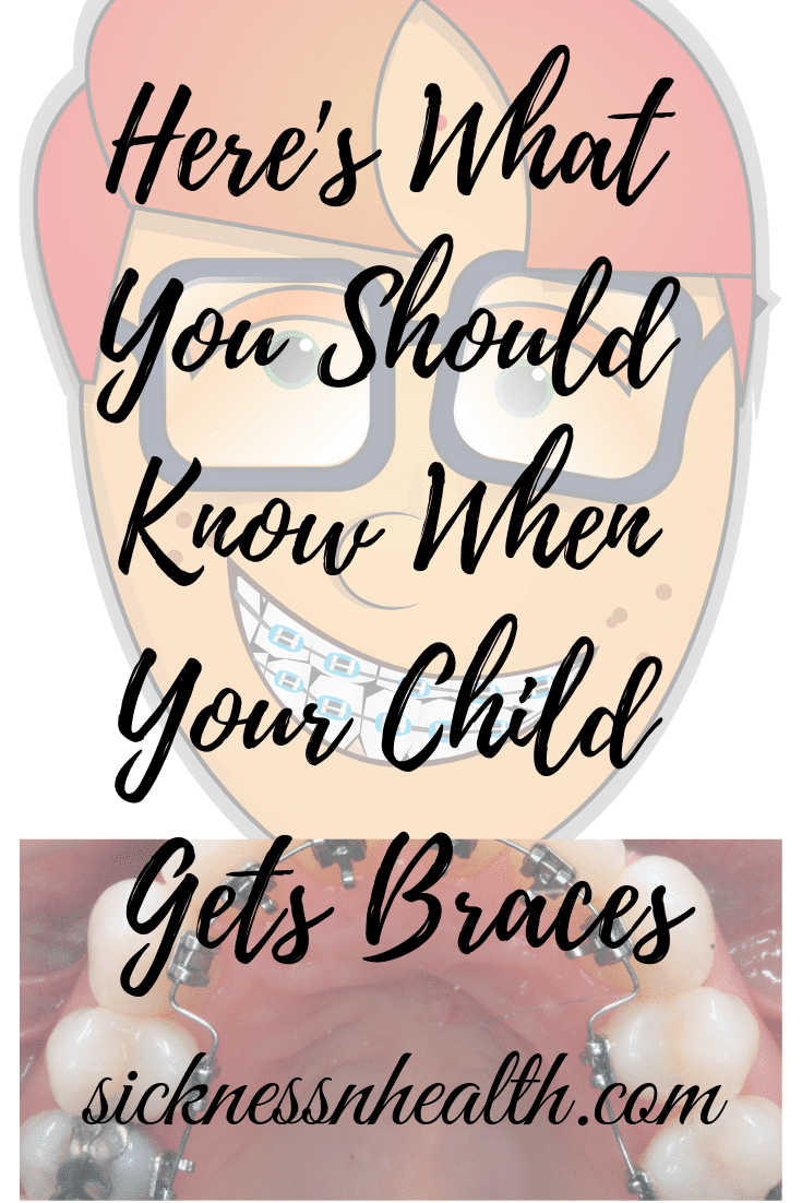 Here's What You Should Know When Your Child Gets Braces