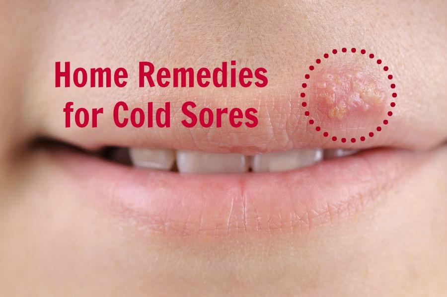 Home Remedies for Cold Sores. 