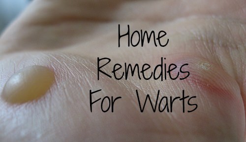 home remedies for warts