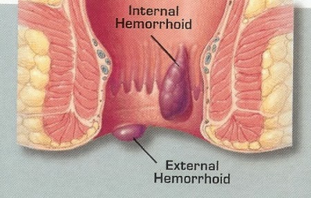 Natural Healing For Hemorrhoids
