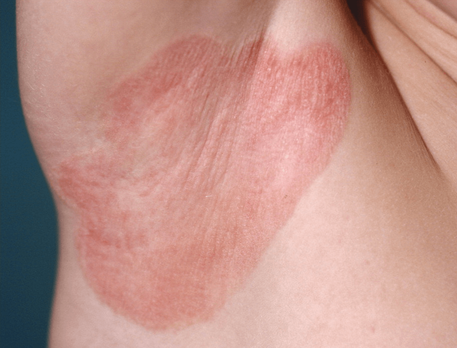 inverse psoriasis 