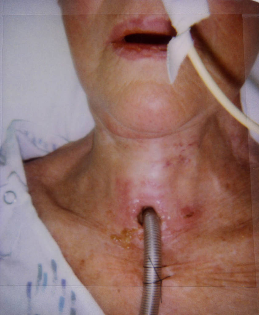 Laryngectomy Post Op Care