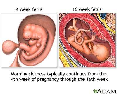 how to cure morning sickness