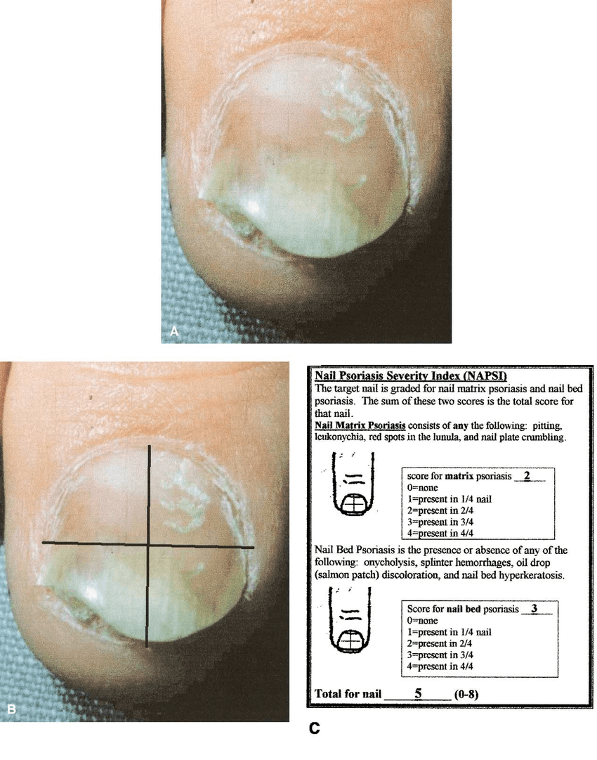 A, Photograph shows psoriatic nail for grading. B, The nail is divided into quadrants, and each quadrant is evaluated for nail matrix and nail bed psoriasis. C, Instruction and grading form for grading psoriatic nails with the Nail Psoriasis Severity Index (NAPSI) (NAPSI scoring for A and B).