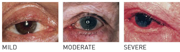 Ocular rosacea