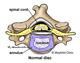 how to cure neck pain