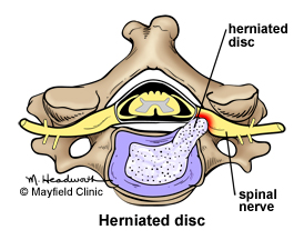 how to cure neck pain